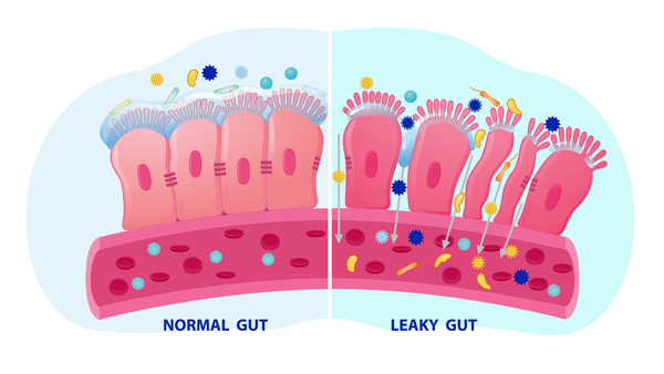 Leaky What? “Leaky Gut” and What It Means for Your Health